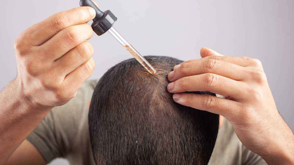 Quem tem mais efeitos colaterais: finasterida ou minoxidil